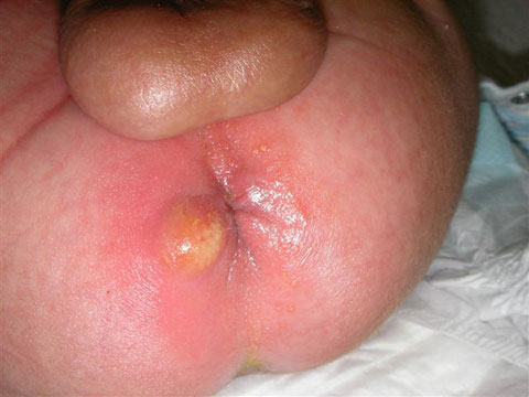 肛門周囲膿瘍　一例